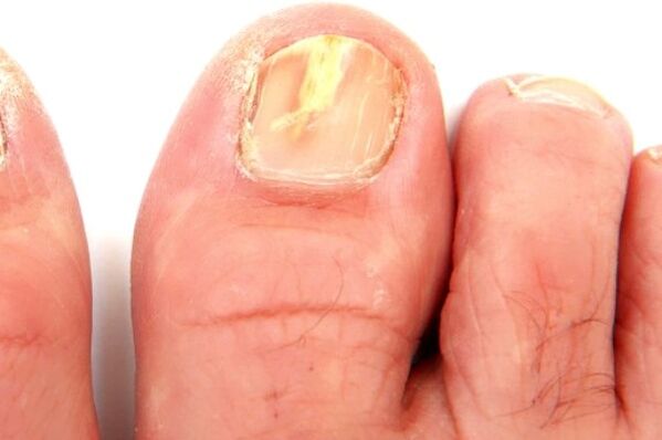 βλάβη στην πλάκα των νυχιών λόγω μυκητιασικής λοίμωξης