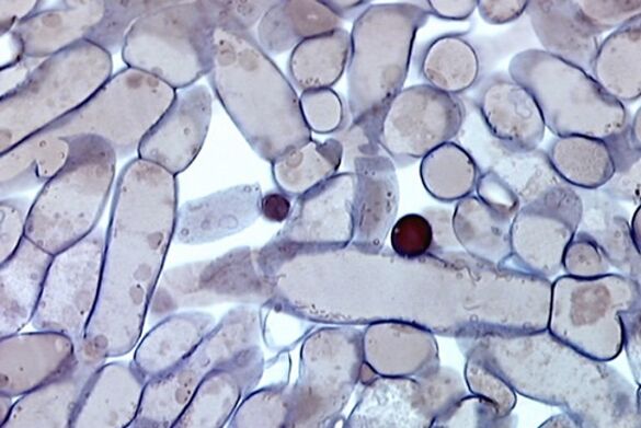 κύτταρα μύκητα νυχιών κάτω από μικροσκόπιο